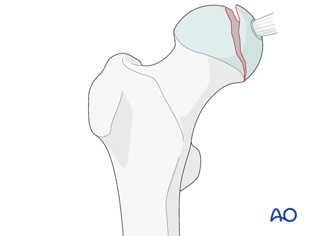 Suprafoveal split fracture of the femoral head