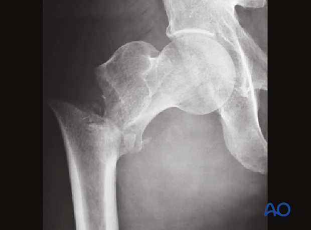 X-ray of a low lateral escape fracture