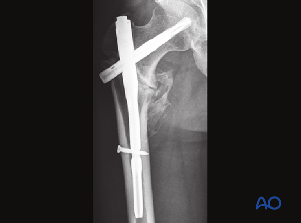 X-ray of an intertochanteric fracture fixed with a short intramedullary nail