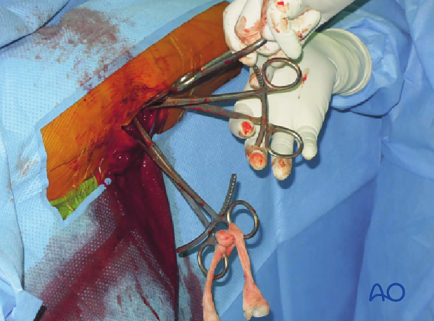 Clinical picture of a simple oblique intertochanteric fracture reduced with Weber forceps