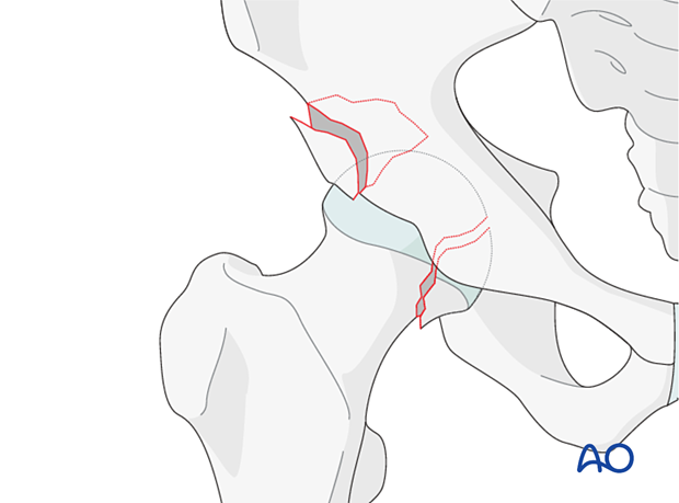 Combined fracture of the femoral head and posterior wall of the acetabulum