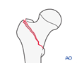 Simple two-part pertrochanteric fracture