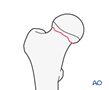 Subcapital femoral neck fractures with little or no displacement