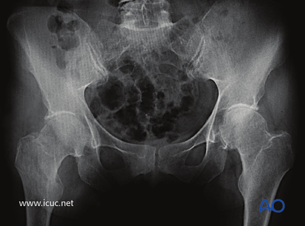 Preoperative AP image of the pelvis showing right intertrochanteric fracture