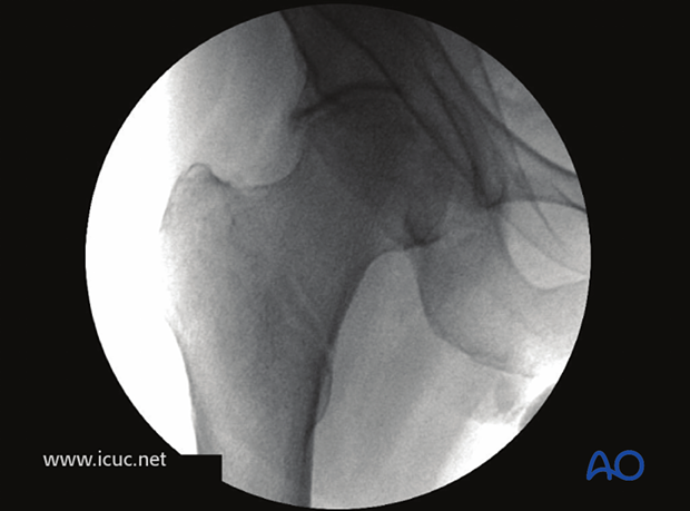 Initial images in the operating room with the patient in traction showing the fracture reduced