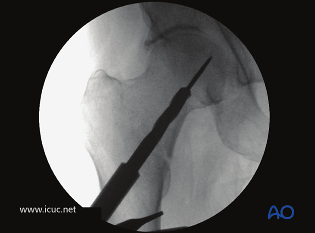 This image demonstrates insertion of the triple reamer.