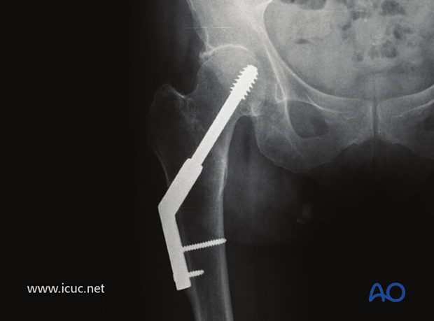 2 years postoperative image showing complete healing. It is recommended that two bicortical screws are placed in the DHS side plate.