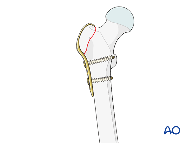 Hook plate fixation of isolated greater trochanteric fractures