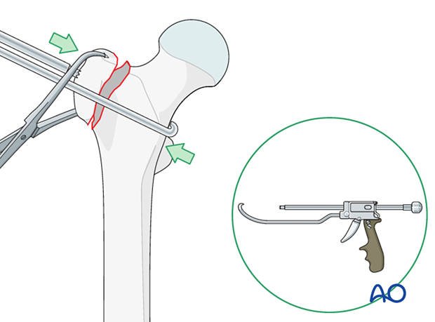 Collinear reduction forceps for reduction and stabilization of isolated greater trochanteric fractures