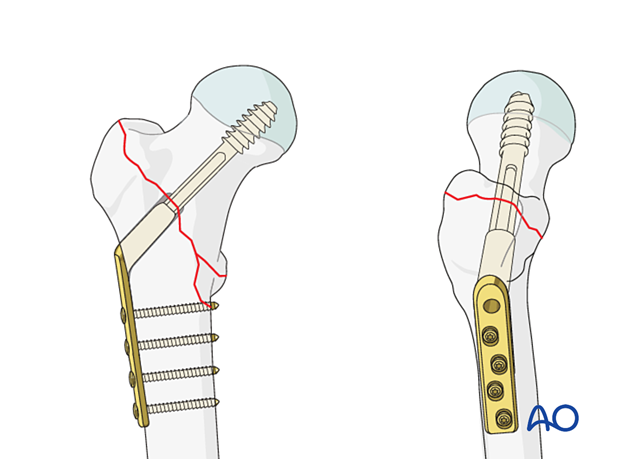 Fixation of a pertrochanteric fracture with a sliding hip screw