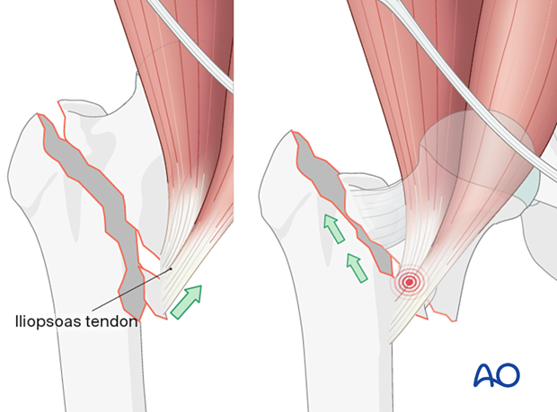 Pull of the iliopsoas muscle on the proximal fragment (left illustration) and superolateral displacement of the shaft after high-energy trauma (right illustration) in pertrochanteric fractures