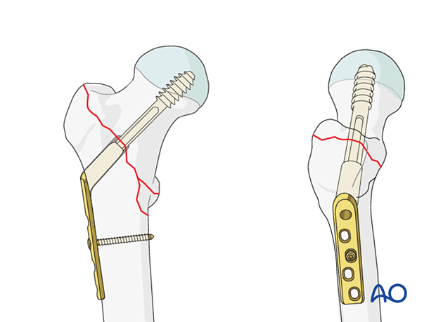 Fixation of a pertrochanteric fracture with a sliding hip screw