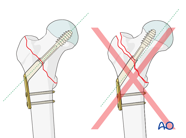 Correct and incorrect implant angle of a sliding hip screw