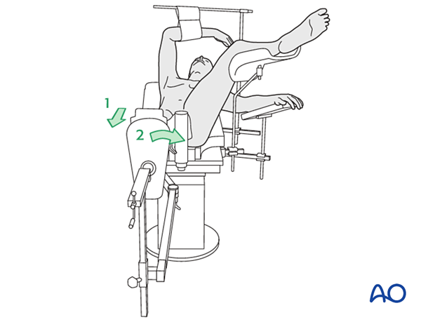 Closed reduction of a pertrochanteric fracture with pulling and internal rotation on a fracture table