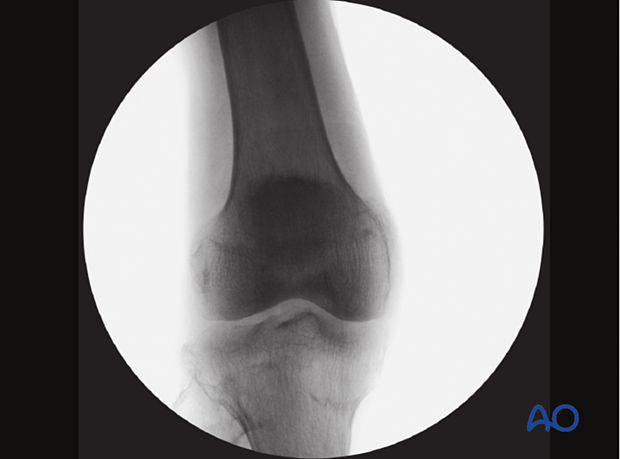 AP view of the patella