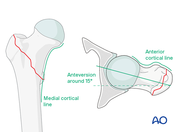 Patterns in AP and lateral view for acceptable reduction of pertrochanteric fractures