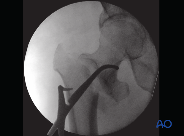 Reduction of a trochanteric fracture with pointed reduction forceps