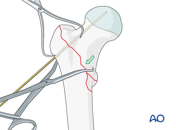 Reduction of a pertrochanteric fracture with pointed reduction forceps