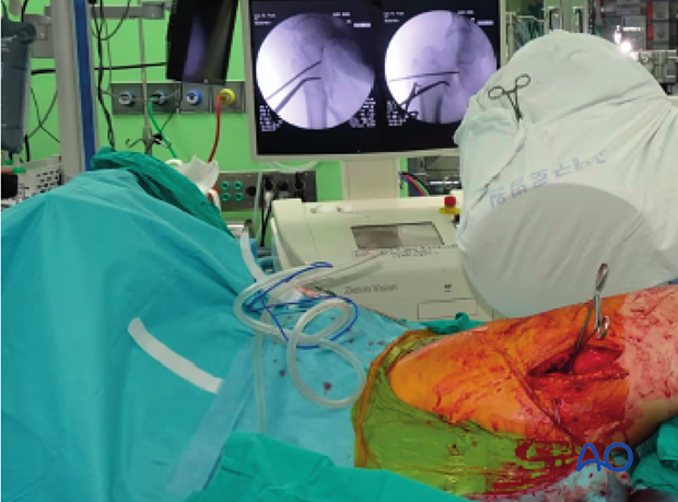 Clinical photograph showing C-arm position for lateral imaging of trochanteric fracture reduction with pointed reduction forceps and K-wire