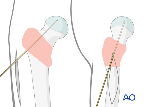 Antirotation wire to avoid rotational displacement of pertrochanteric fractures during sliding hip screw insertion