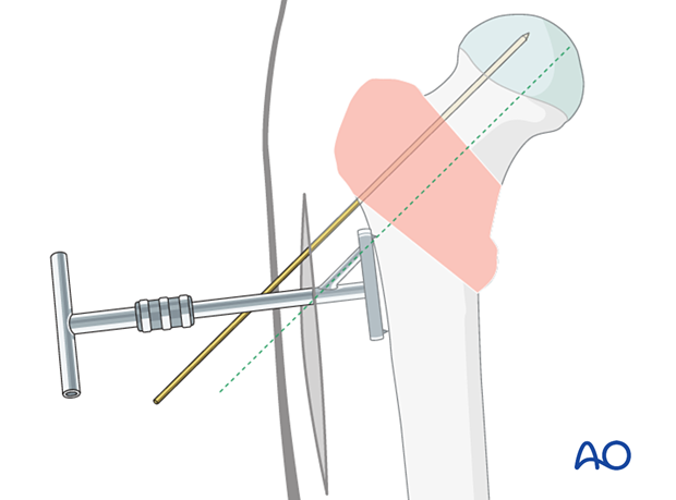 Aiming device positioned for insertion of the sliding hip screw guide wire