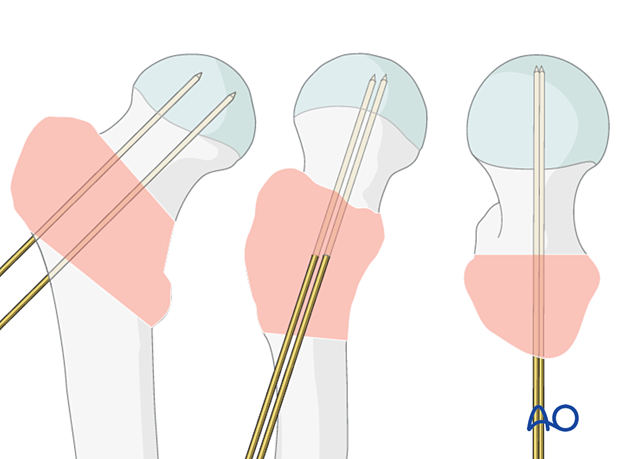 Guide and antirotation wire inserted for sliding hip screw application