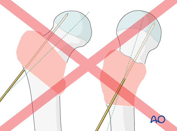 Incorrect guide-wire insertion for sliding hip screw application