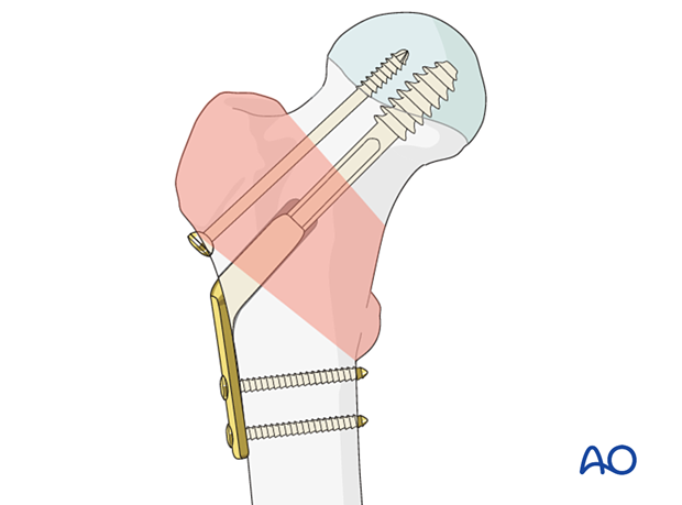 Fixation of a pertrochanteric fracture with a sliding hip screw and antirotation screw