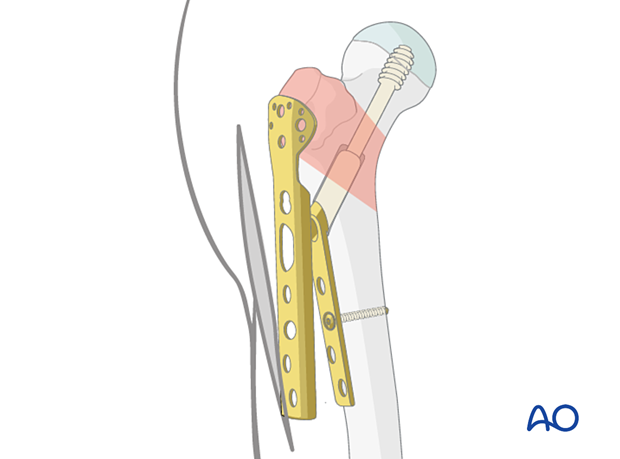 Application of a trochanter stabilization plate (TSP) over a DHS plate