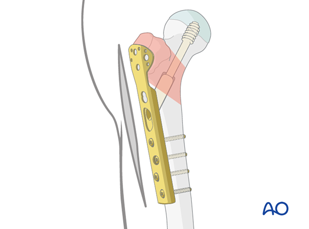 Fixation of a pertrochanteric fracture with a sliding hip screw and trochanter stabilization plate