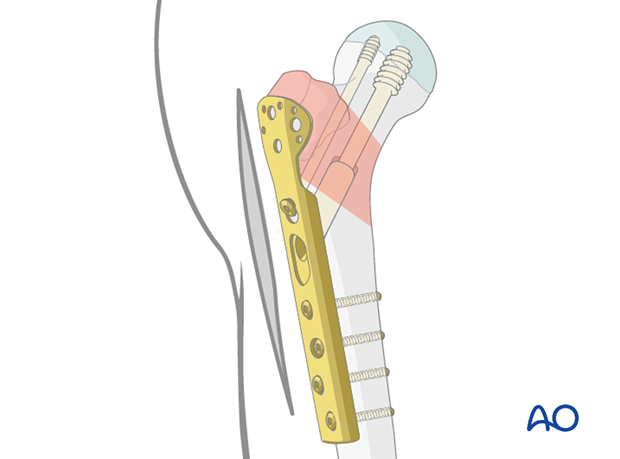 Fixation of a pertrochanteric fracture with a sliding hip screw and trochanter stabilization plate