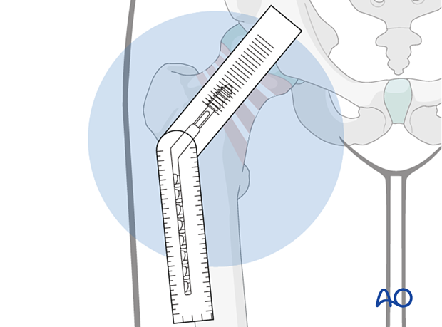 Measuring the femoral neck-shaft angle from the AP view after reduction for selection of the correct sliding hip screw implant