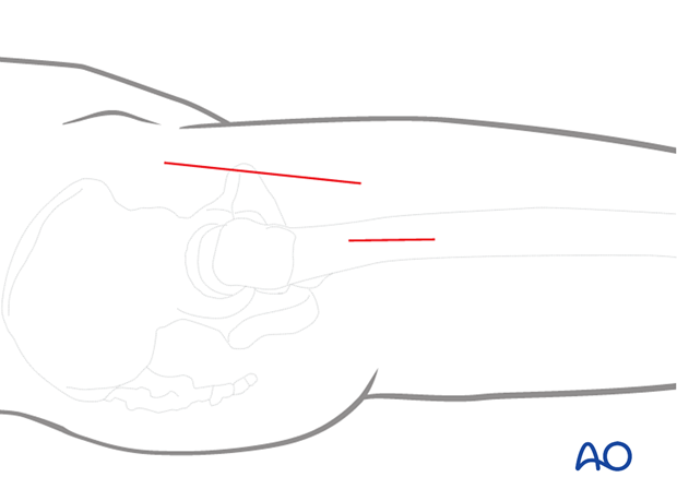 Two-window approach for ORIF of femoral neck fractures with a Smith-Petersen approach for reduction and a limited lateral approach for insertion of the sliding hip screw