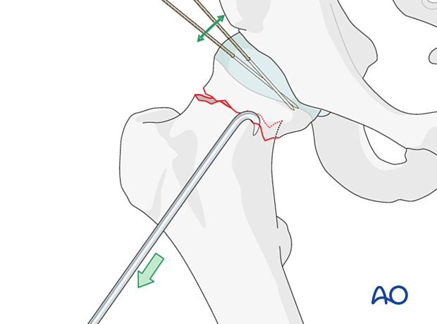 For reduction of femoral neck fractures, head and neck may be manipulated with hooks or K-wires acting as joysticks.