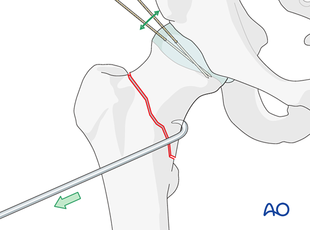 For reduction of femoral neck fractures, head and neck may be manipulated with hooks or K-wires acting as joysticks.