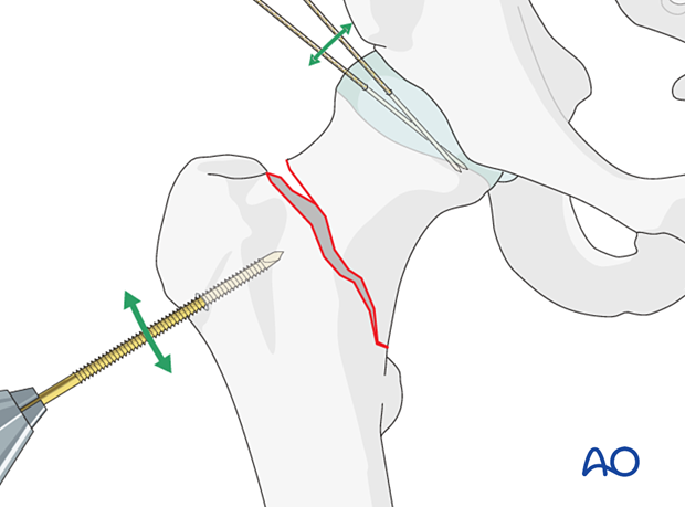 For reduction of femoral neck fractures, the distal fragment may be manipulated with a Schanz screw and the head and neck fragment with hooks or K-wires acting as joysticks.