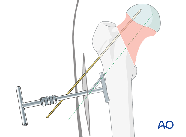 Aiming device positioned for insertion of the sliding hip screw guide wire