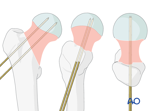 Guide and antirotation wire inserted for sliding hip screw application