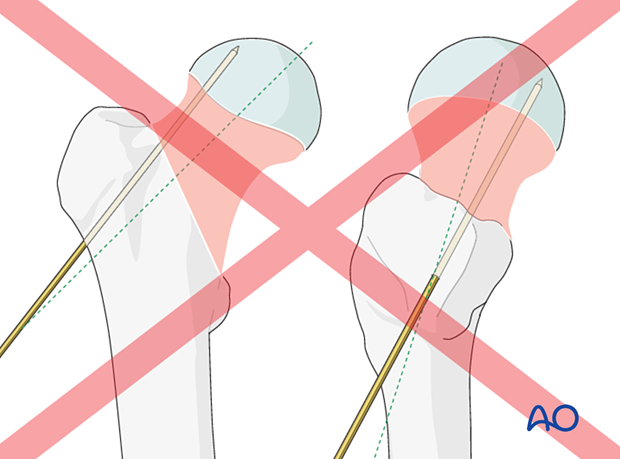 Incorrect guide-wire insertion for sliding hip screw application