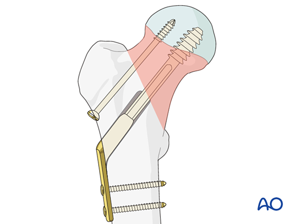 Fixation of a femoral neck fracture with a sliding hip screw and antirotation screw