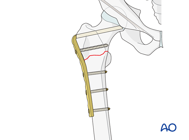 Intertrochanteric fracture fixed with an angled blade plate