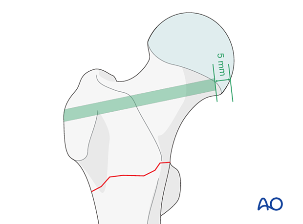 Blade track for fixation of an intertrochanteric fracture with an angled blade plate