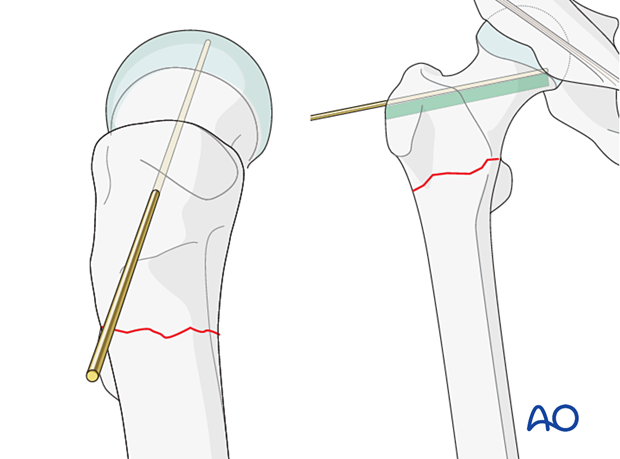 Guide wire inserted parallel to the blade track for fixation of an intertrochanteric fracture with an angled blade plate