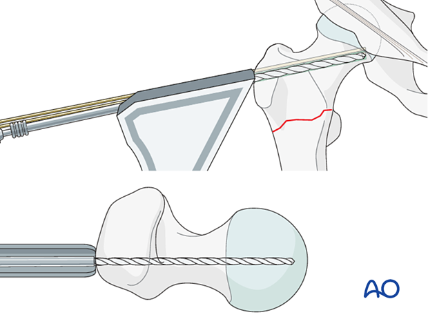 Drilling the blade track for fixation of an intertrochanteric fracture with an angled blade plate