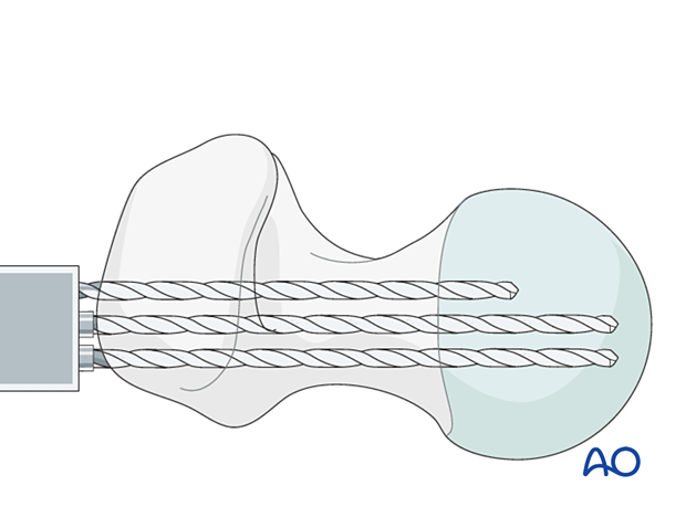 Drilling the blade track for fixation of an intertrochanteric fracture with an angled blade plate