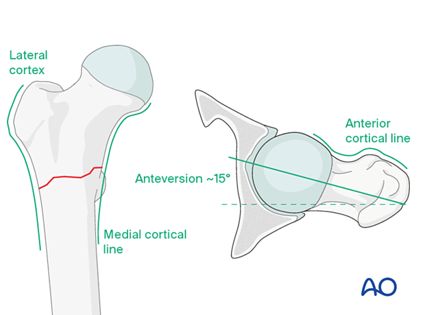 Patterns in AP and lateral view for acceptable reduction of intertrochanteric fractures