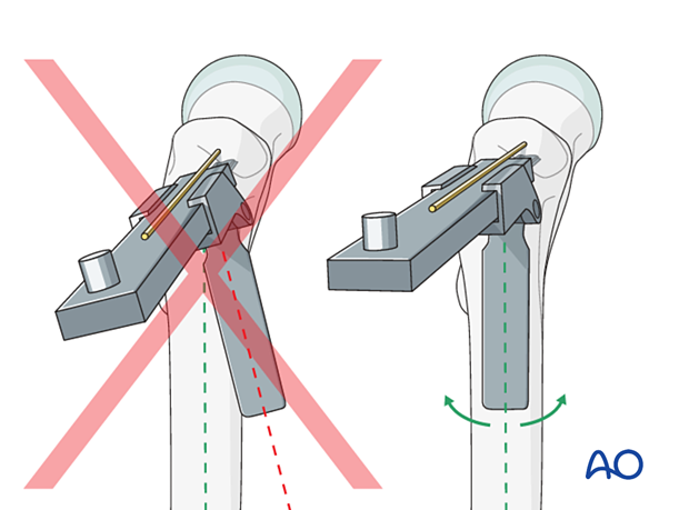 Inserting a chisel along the blade track for fixation of an intertrochanteric fracture with an angled blade plate