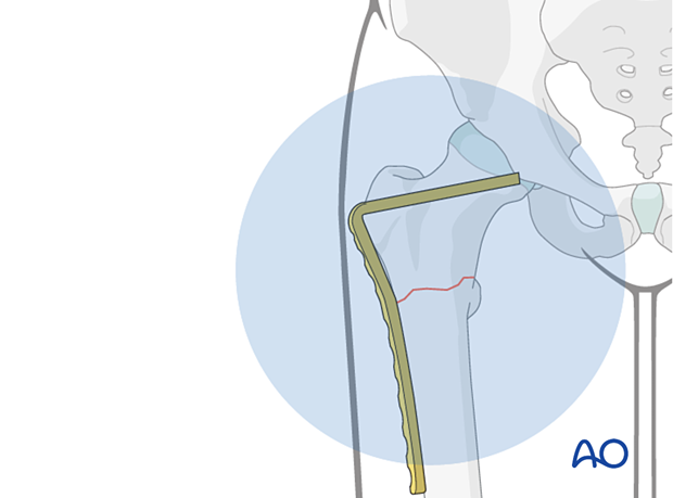 Position the planned plate on the skin with the distal part parallel to the femoral shaft and take an AP view.