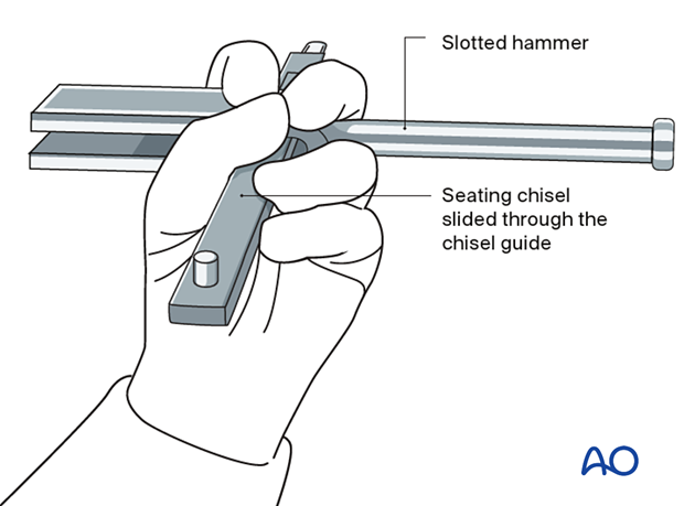 Manual control of the chisel for fixation of an intertrochanteric fracture with an angled blade plate