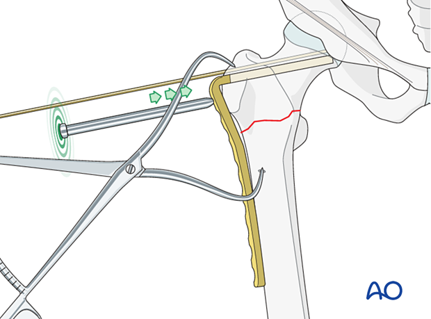 Blade insertion with an impactor during fixation of an intertrochanteric fracture with an angled blade plate